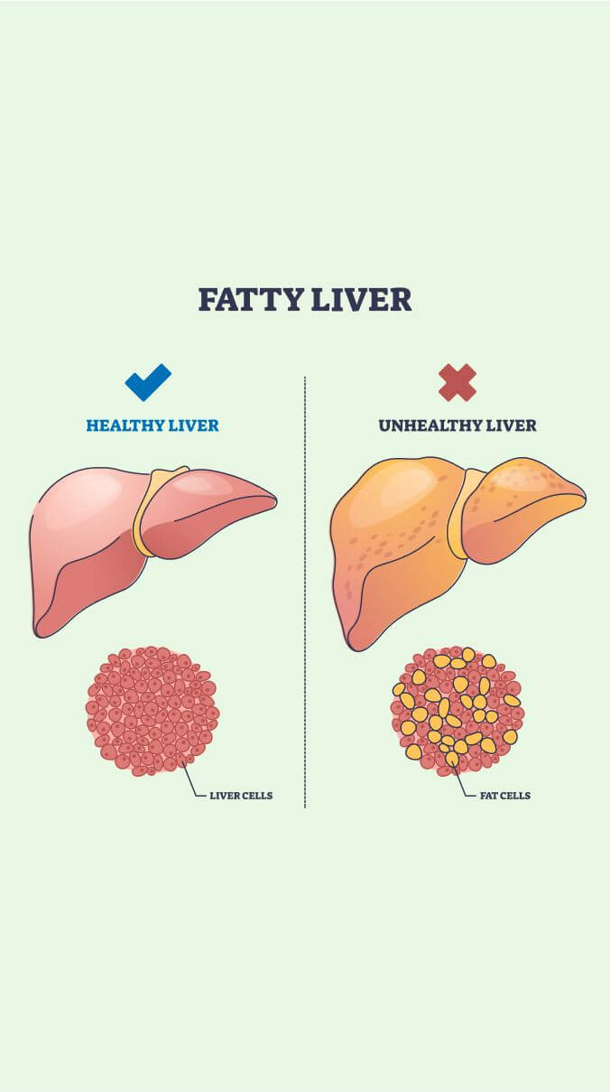 Fatty liver